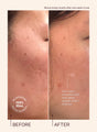 A before and after comparison of someone using Travel Size Glass Skin Refining Serum, where the after image clearly shows that their skin looks smoother and dark spots appear visibly brighter for easier blending with the skin tone