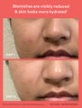 Acne Routine